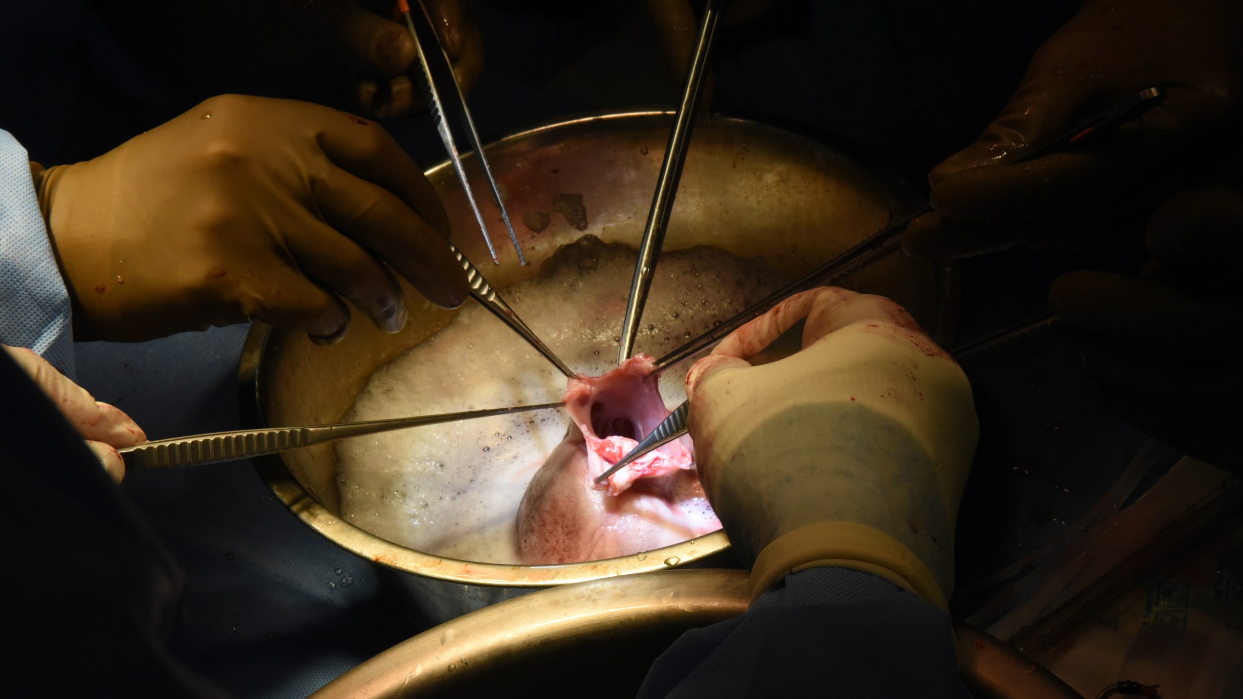 CORRECTS BYLINE TO MARK TESKE, NOT DEBORAH KOTZ - In this photo provided by the University of Maryland School of Medicine, surgeons perform a pig heart transplant into Lawrence Faucette at the school's hospital in Baltimore, Md., in September 2023. Two days after the transplant, Lawrence was cracking jokes and able to sit in a chair, doctors said Friday, Sept. 22, 2023. (Deborah Kotz/University of Maryland School of Medicine via AP)