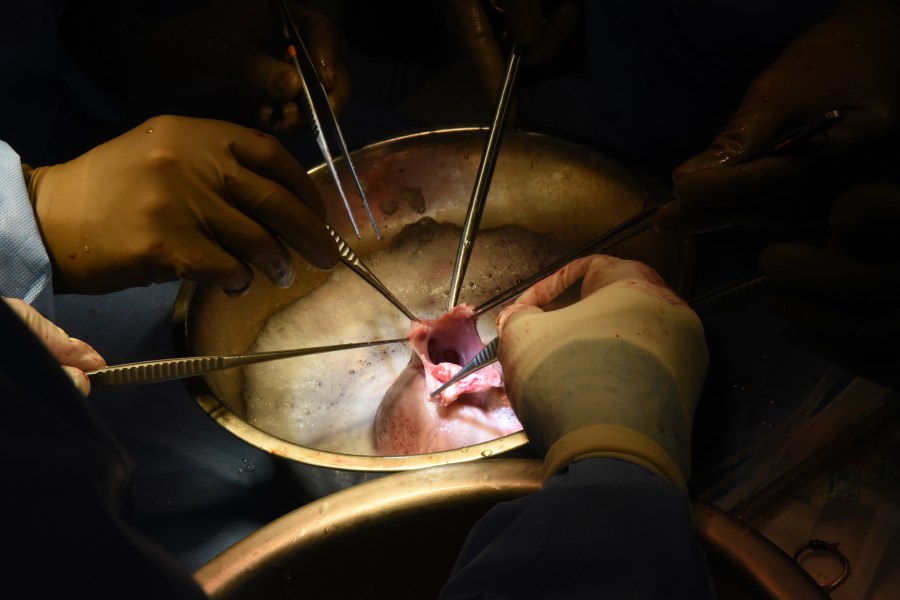 CORRECTS BYLINE TO MARK TESKE, NOT DEBORAH KOTZ - In this photo provided by the University of Maryland School of Medicine, surgeons perform a pig heart transplant into Lawrence Faucette at the school's hospital in Baltimore, Md., in September 2023. Two days after the transplant, Lawrence was cracking jokes and able to sit in a chair, doctors said Friday, Sept. 22, 2023. (Deborah Kotz/University of Maryland School of Medicine via AP)