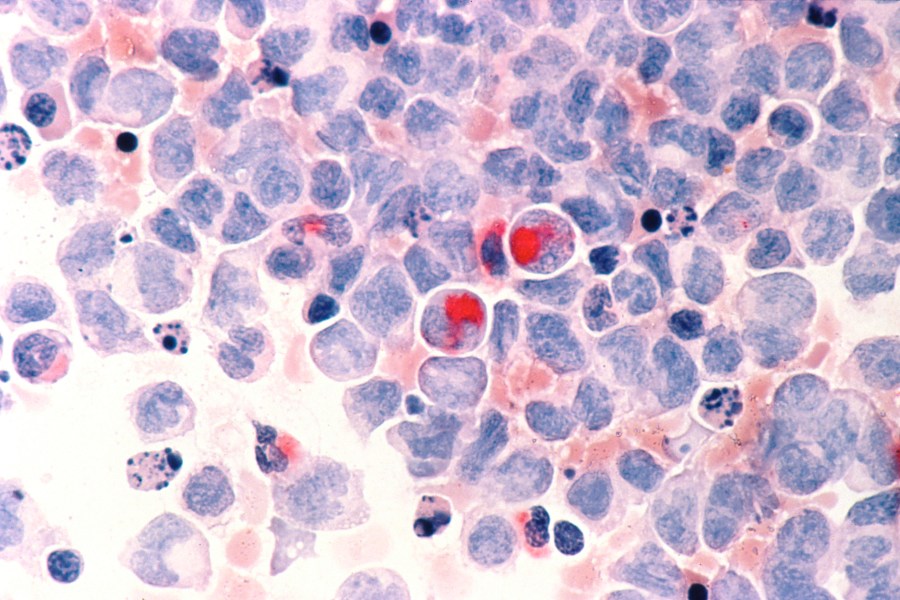 This March 1988 microscope photo provided by the National Cancer Institute shows human cells with acute myelocytic leukemia. Advances in childhood cancer are a success story in modern medicine. But in the past decade, those strides have stalled for Black and Hispanic youth, opening a gap in death rates, according to a new report published Thursday, Nov. 16, 2023. (National Cancer Institute via AP)