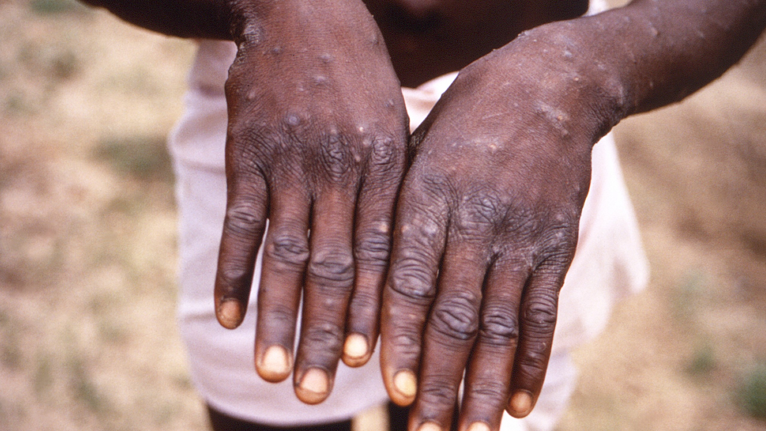 FILE - This 1997 image provided by the CDC during an investigation into an outbreak of monkeypox, which took place in the Democratic Republic of the Congo (DRC), formerly Zaire, depicts the dorsal surfaces of the hands of a monkeypox case patient, who was displaying the appearance of the characteristic rash during its recuperative stage. As Congo copes with its biggest outbreak of mpox, scientists warn discrimination against gay and bisexual men on the continent could make it worse. (CDC via AP, File)