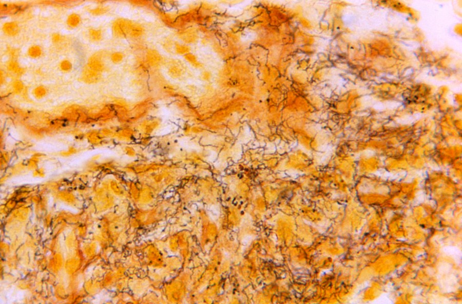 FILE - This 1966 microscope photo made available by the Centers for Disease Control and Prevention shows a tissue sample with the presence of numerous, corkscrew-shaped, darkly-stained, Treponema pallidum spirochetes, the bacterium responsible for causing syphilis. The U.S. syphilis epidemic continues to worsen, according to a new government report released Tuesday, Jan. 30, 2024, that also contains some unexpected good news — the rate of new gonorrhea cases has fallen for the first time in a decade. (Skip Van Orden/CDC via AP, File)