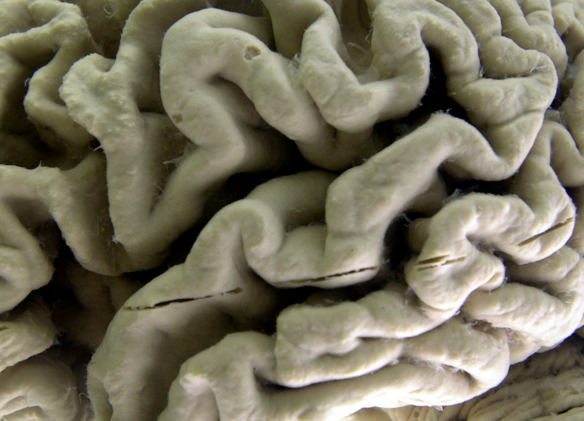 FILE - A closeup of a human brain affected by Alzheimer's disease, is displayed at the Museum of Neuroanatomy at the University at Buffalo in Buffalo, N.Y., on Oct. 7, 2003. According to findings published Wednesday, Feb. 21, 2024 in the New England Journal of Medicine, Alzheimer’s quietly ravages the brain long before symptoms appear and now scientists are getting a closer look at the domino-like sequence of those changes _ a potential window to one day intervene. (AP Photo/David Duprey)