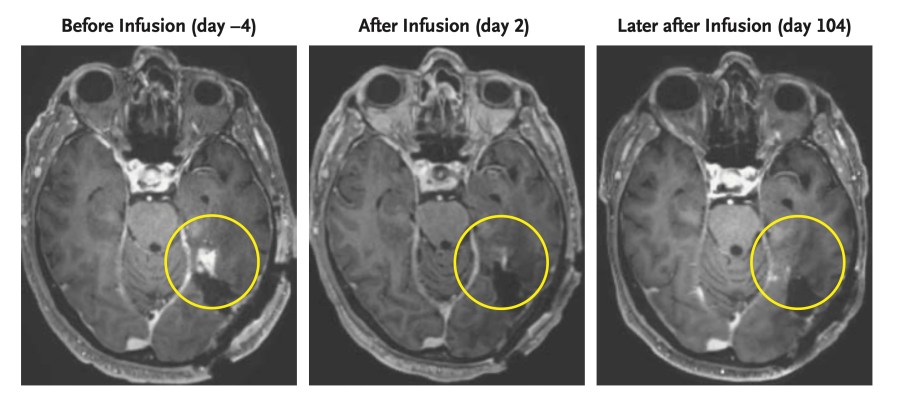 This combination of MRI scan images provided by the New England Journal of Medicine in March 2024 shows the progress of a glioblastoma patient who received CAR-T therapy which uses modified versions of T cells from a patient's own immune system. Studies published by the New England Journal of Medicine on Wednesday, March 13, 2024, signals a new strategy to fight glioblastoma by turning immune cells into “living drugs” that attack the brain cancer. (NEJM via AP)