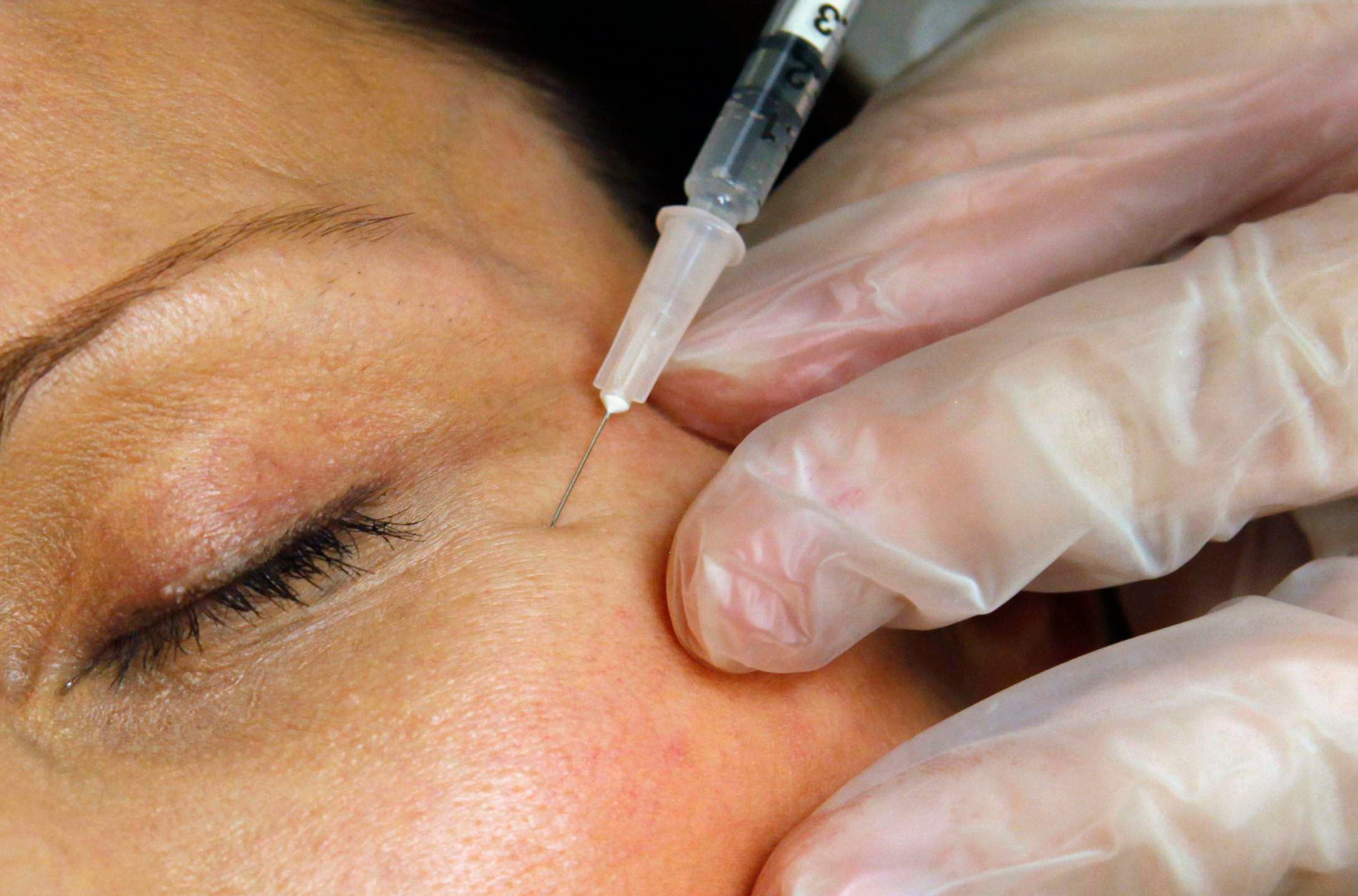 A patient receives a Botox injection at a clinic in Arlington, Va., on June 5, 2009. On Tuesday, April 23, 2024, the Centers for Disease Control and Prevention issued a warning about counterfeit Botox injections after more than 20 people got sick. All of the people told health officials that they got the shots from unlicensed individuals or in settings like homes or spas. (AP Photo/Jacquelyn Martin, File)