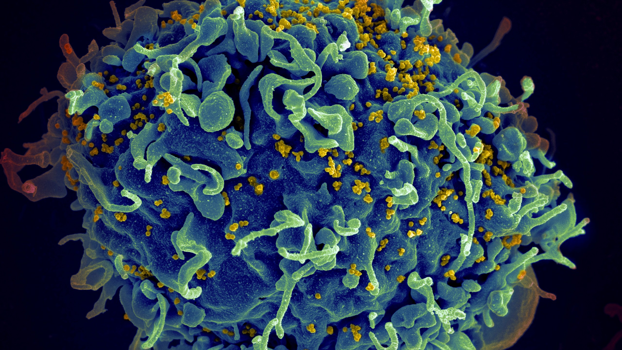 FILE - This electron microscope image made available by the U.S. National Institutes of Health shows a human T cell, in blue, under attack by HIV, in yellow, the virus that causes AIDS. Three women who were diagnosed with HIV after getting “vampire facial” procedures at an unlicensed New Mexico medical spa are the first believed to have contracted the virus through a cosmetic procedure using needles, according to federal health officials. (Seth Pincus, Elizabeth Fischer, Austin Athman/National Institute of Allergy and Infectious Diseases/NIH via AP, File)