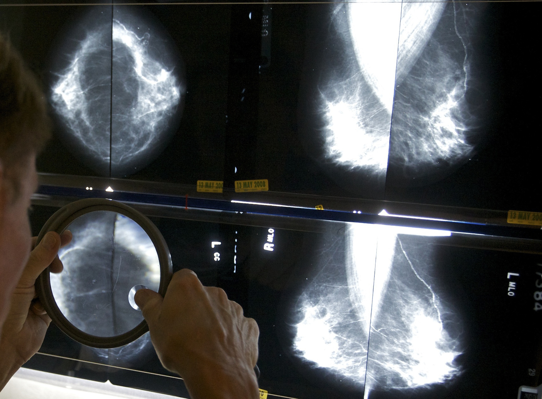 FILE - A radiologist uses a magnifying glass to check mammograms for breast cancer in Los Angeles, May 6, 2010. An influential U.S. task force now says women should get screened for breast cancer every other year starting at age 40. The U.S. Preventive Services Task Force announced the updated guidance Tuesday, April 30, 2024. (AP Photo/Damian Dovarganes, File)