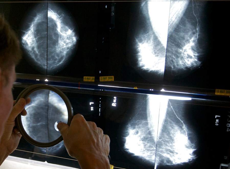 FILE - A radiologist uses a magnifying glass to check mammograms for breast cancer in Los Angeles, May 6, 2010. An influential U.S. task force now says women should get screened for breast cancer every other year starting at age 40. The U.S. Preventive Services Task Force announced the updated guidance Tuesday, April 30, 2024. (AP Photo/Damian Dovarganes, File)