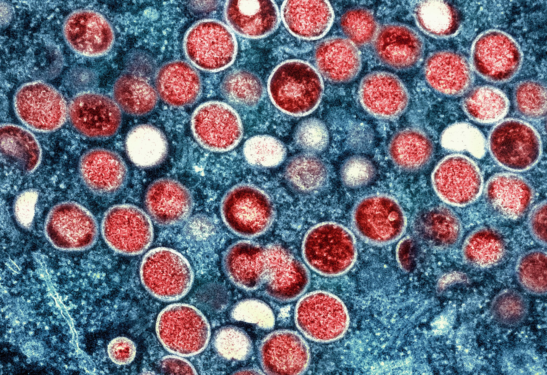 FILE - This image provided by the National Institute of Allergy and Infectious Diseases (NIAID) shows a colorized transmission electron micrograph of monkeypox particles (red) found within an infected cell (blue), cultured in the laboratory that was captured and color-enhanced at the NIAID Integrated Research Facility (IRF) in Fort Detrick, Md. Scientists say a new form of mpox detected in a mining town in Congo might more easily spread among people. Already, Congo is seeing its biggest mpox outbreak with more than 19,000 suspected infections and 900 deaths. (NIAID via AP, File)