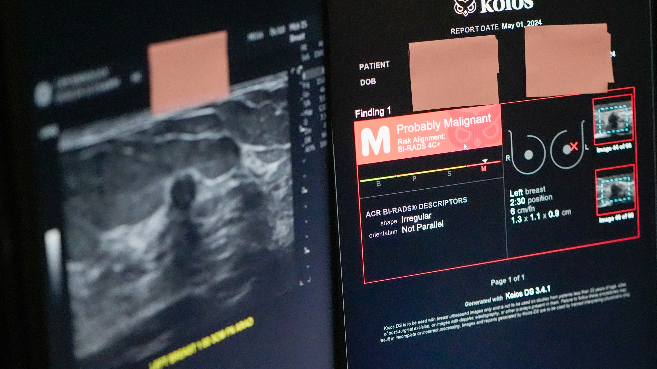 The Koios DS Smart Ultrasound software, used to get a second opinion on mammography images, is seen on a computer screen, Wednesday, May 8, 2024, at Mount Sinai hospital in New York. In the near term, experts say AI will work like autopilot systems on planes — performing important navigation functions, but always under the supervision of a human pilot. (AP Photo/Mary Altaffer)