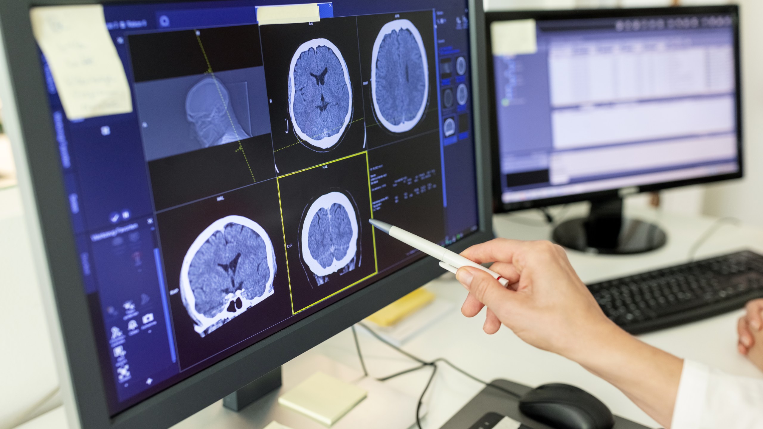 Close-up of female doctor looking at CT scan report on computer monitor. Surgeon with pen viewing at X-ray image on computer screen in hospital.