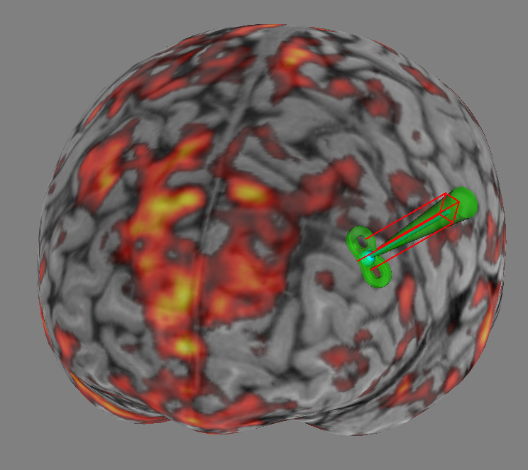 Researchers non-invasively stimulated a deep brain region linked to depression called the subgenual anterior cingulate cortex (sgACC).