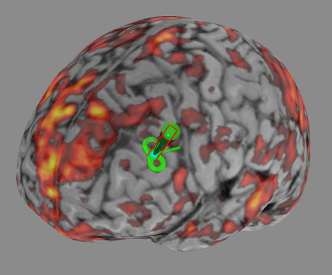 Researchers non-invasively stimulated a deep brain region linked to depression called the subgenual anterior cingulate cortex (sgACC).