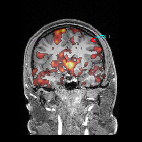 Researchers non-invasively stimulated a deep brain region linked to depression called the subgenual anterior cingulate cortex (sgACC).