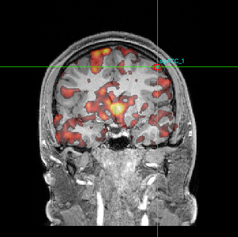 Researchers non-invasively stimulated a deep brain region linked to depression called the subgenual anterior cingulate cortex (sgACC).