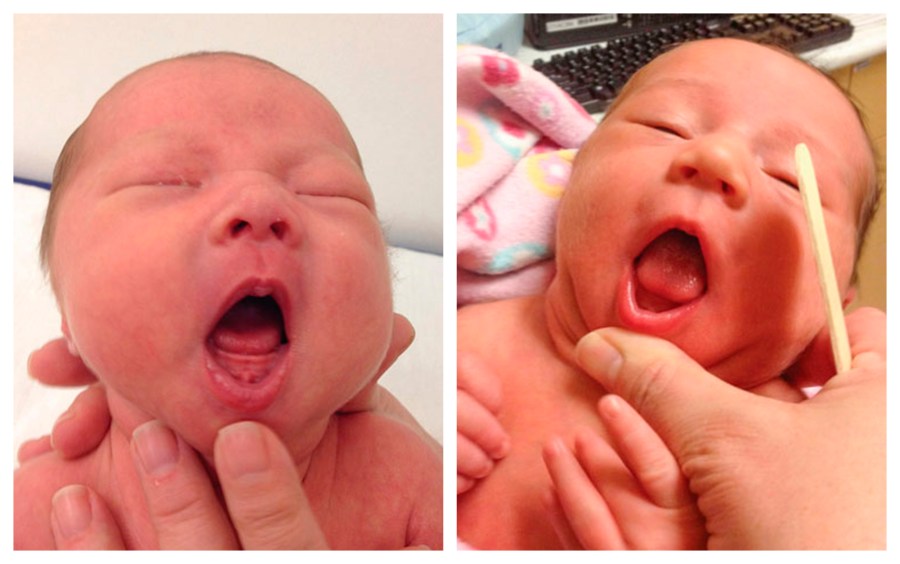 This combination of photos provided by Dr. Maya Bunik in July 2024, shows a baby with ankyloglossia where the tongue does not extend beyond the gums, left, and a baby with an indentation at the tip of a the tongue which may be a sign of ankyloglossia. On Monday, July 29, 2024, one of the largest doctor's groups in the U.S., voiced concerns that the condition, also known as "tongue-tie" which can affect breastfeeding, is being over-diagnosed and often treated with unnecessary surgery to babies' mouths. (Dr. Maya Bunik via AP)