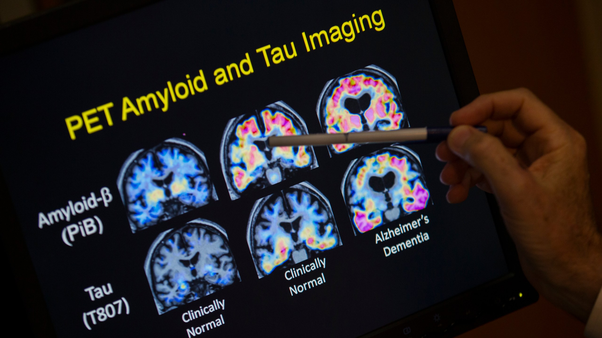 FILE - R. Scott Turner, Professor of Neurology and Director of the Memory Disorder Center at Georgetown University Hospital, points to PET scan results that are part of a study on Alzheimer's disease at Georgetown University Hospital, in Washington, May 19, 2015. (AP Photo/Evan Vucci, File)