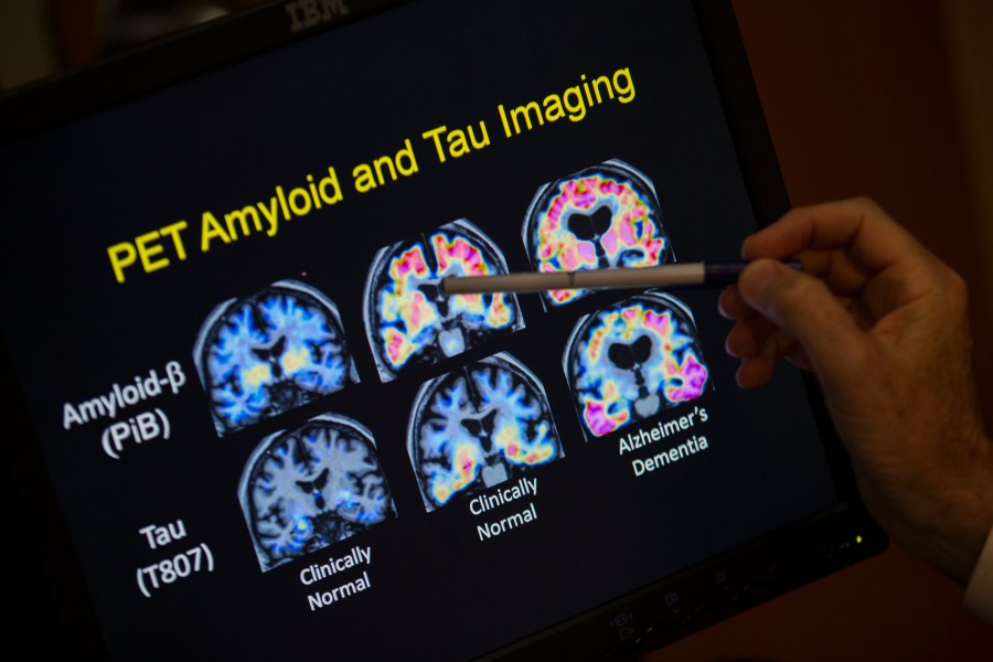 FILE - R. Scott Turner, Professor of Neurology and Director of the Memory Disorder Center at Georgetown University Hospital, points to PET scan results that are part of a study on Alzheimer's disease at Georgetown University Hospital, in Washington, May 19, 2015. (AP Photo/Evan Vucci, File)