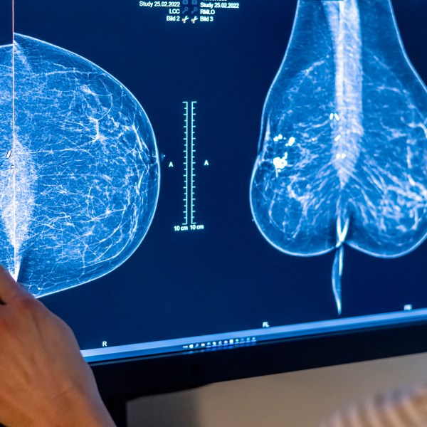 Medical personnel use a mammogram to examine a woman's breast for breast cancer.