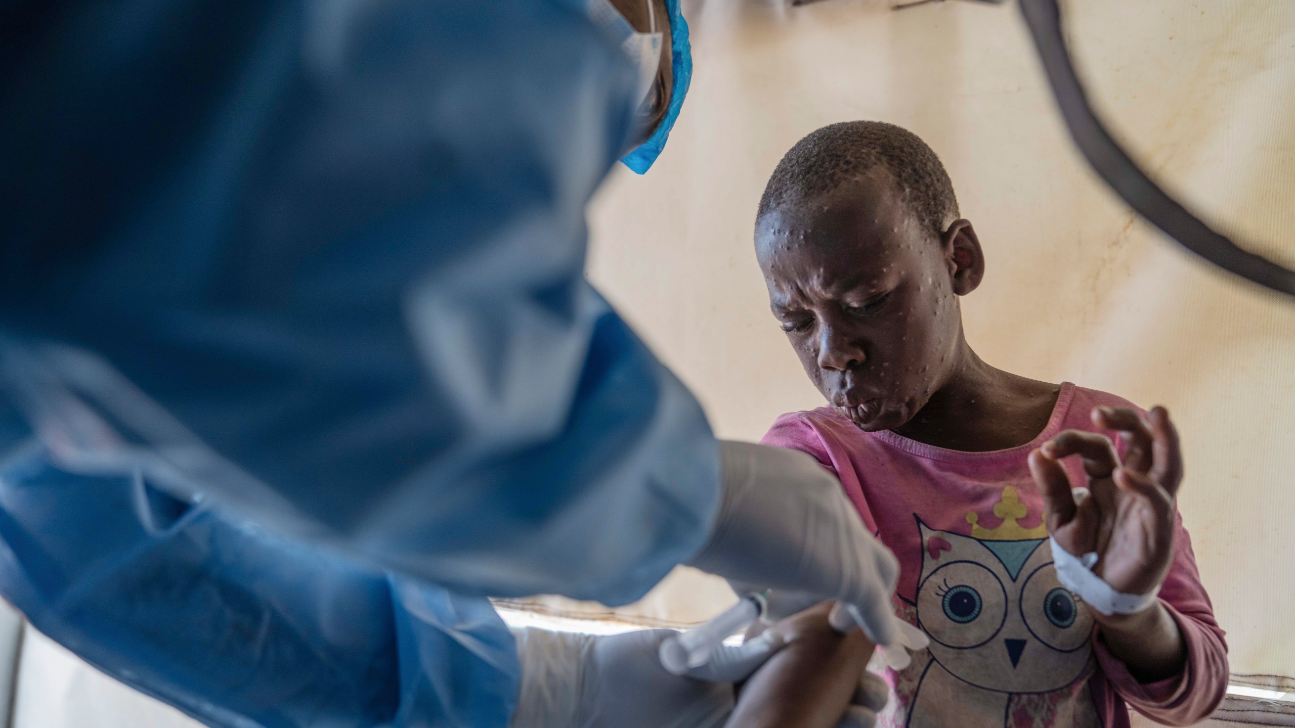 FILE - A health worker attends to a mpox patient, at a treatment centre in Munigi, eastern Congo, Aug. 19, 2024. (AP Photo/Moses Sawasawa, file )