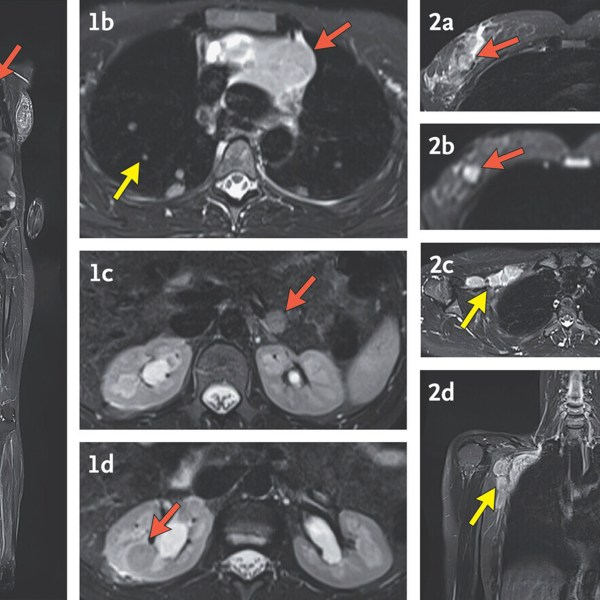 These MRI images with arrows indicating cancer were made during a study by researchers at the National Institutes of Health and published Wednesday, Dec. 4, 2024, in the New England Journal of Medicine. (The New England Journal of Medicine via AP)